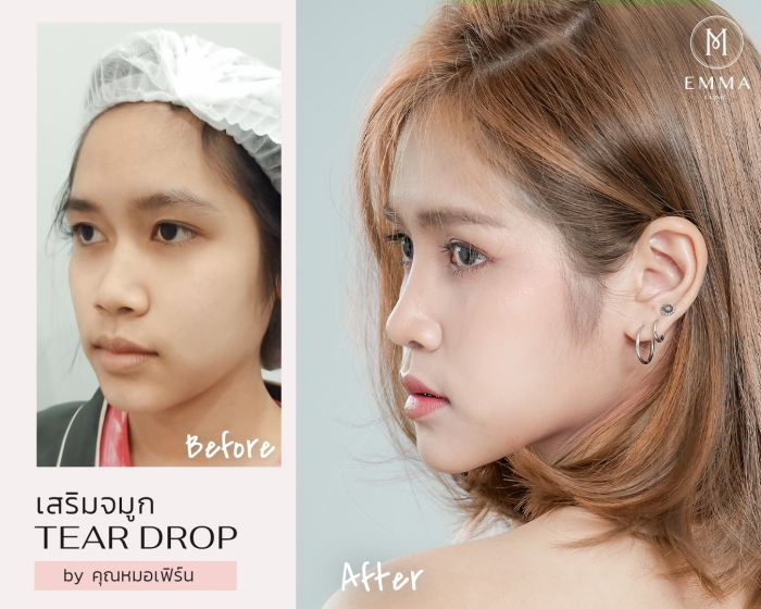 รีวิวเสริมจมูก หมอเฟิร์น